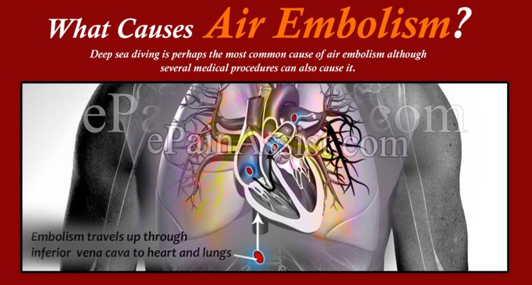 What Causes Air Embolism & What Can Be Done About Air Embolism?