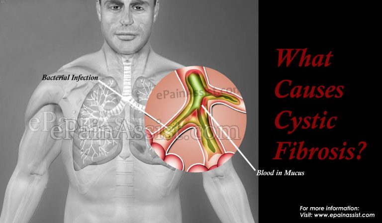 What Causes Cystic Fibrosis?