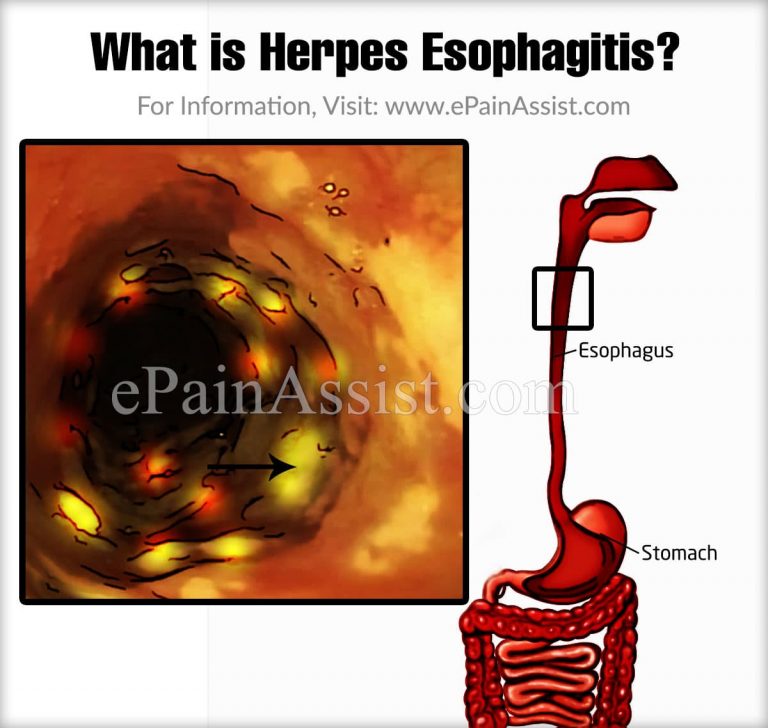 What is Herpes Esophagitis & How is it Treated? | Causes & Symptoms of Herpes Esophagitis