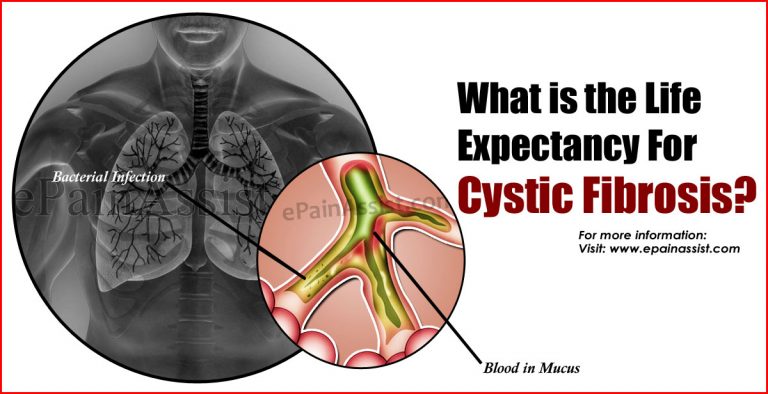 What is the Life Expectancy For Cystic Fibrosis?