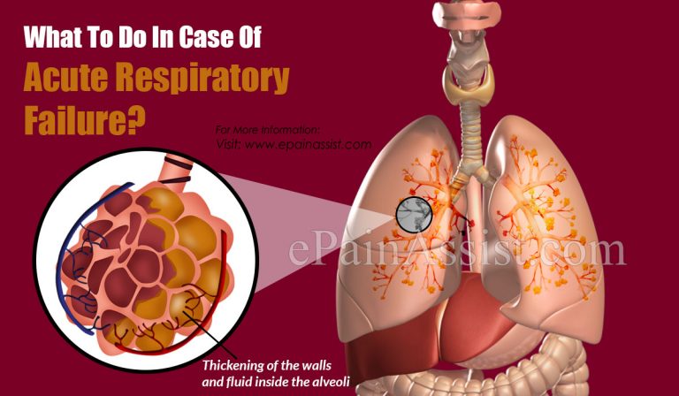 What To Do In Case Of Acute Respiratory Failure?