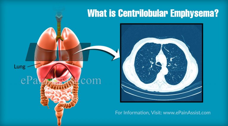 Centrilobular Emphysema: Causes, Symptoms, Treatment
