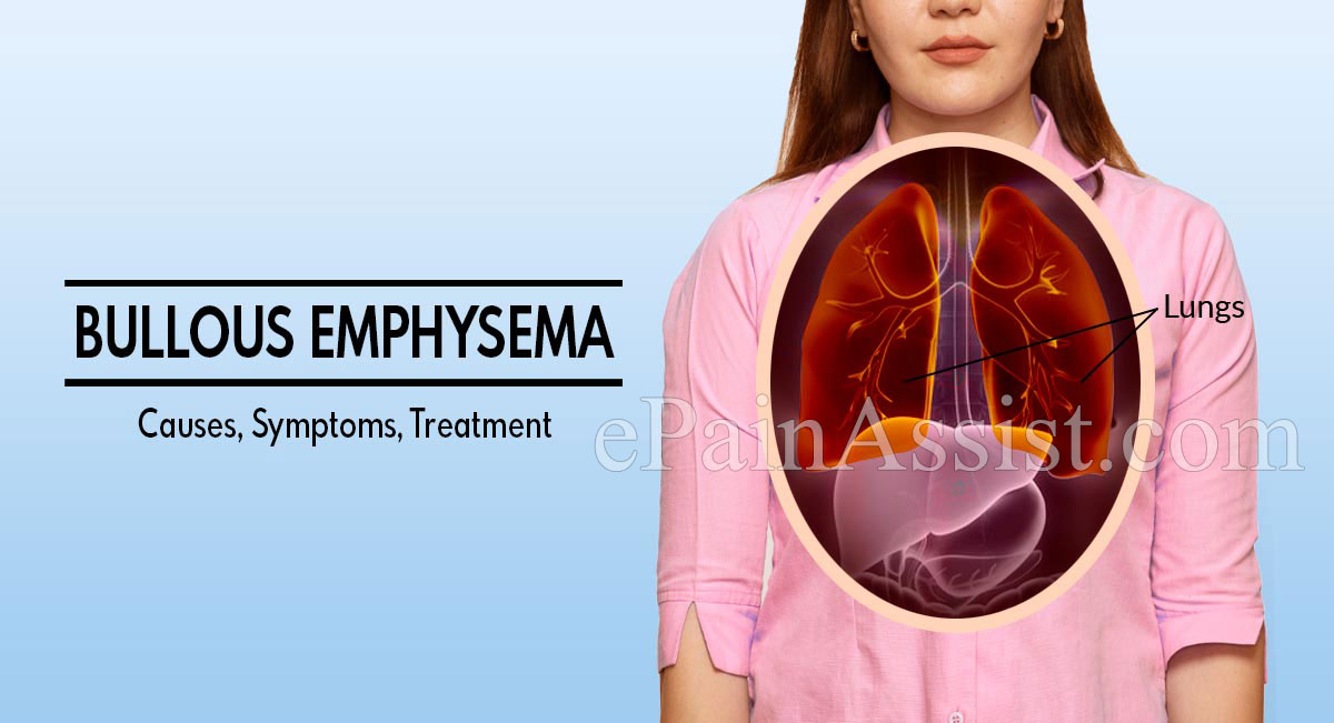 Bullous Emphysema: Causes, Symptoms, Treatment, Diagnosis