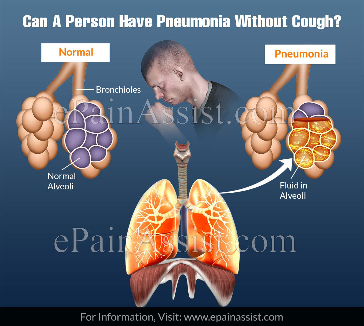 Can A Person Have Pneumonia Without Cough?