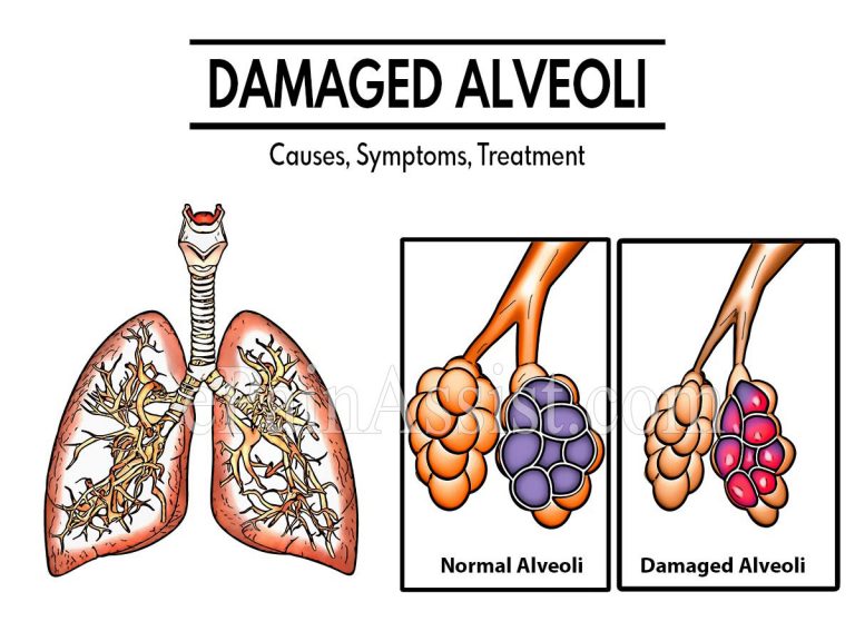 Damaged Alveoli: Causes, Symptoms, Treatment