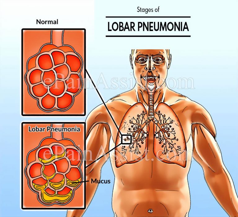 Stages of Lobar Pneumonia