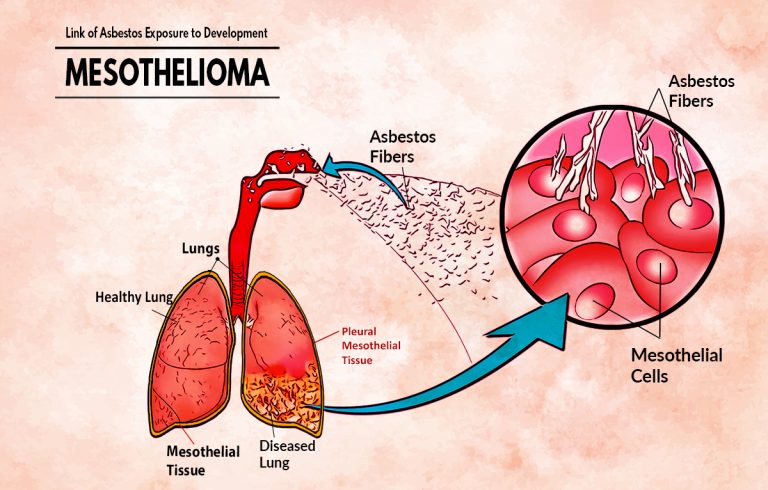 The History of Asbestos Use and the Link Between Asbestos Exposure and Mesothelioma