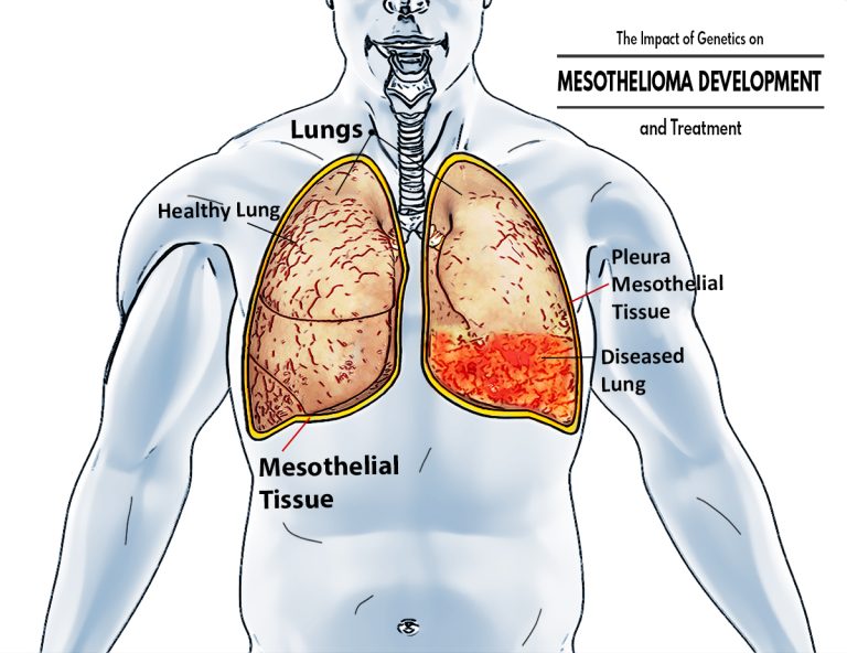 The Impact of Genetics on Mesothelioma Development and Treatment