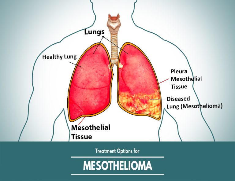 Treatment Options for Mesothelioma : An Overview