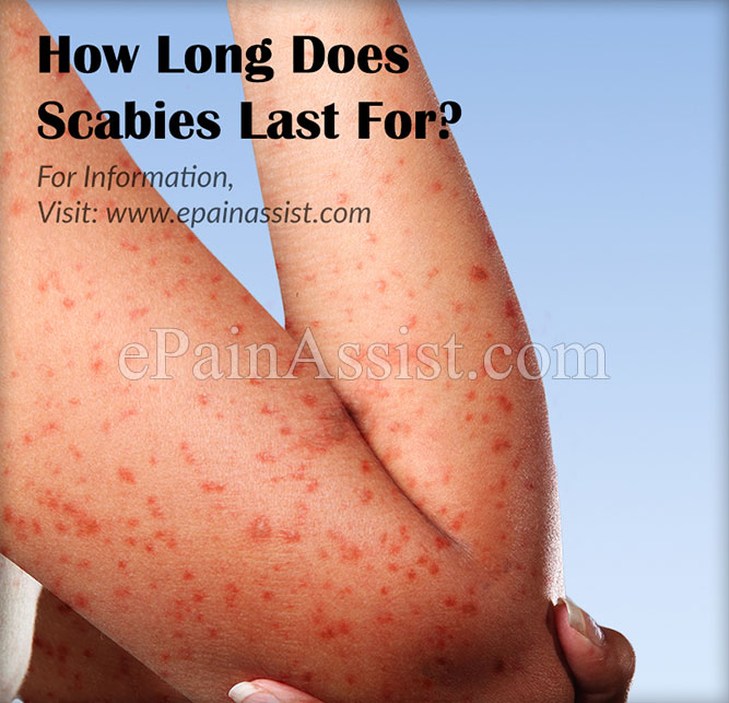 How Long Does Scabies Last?