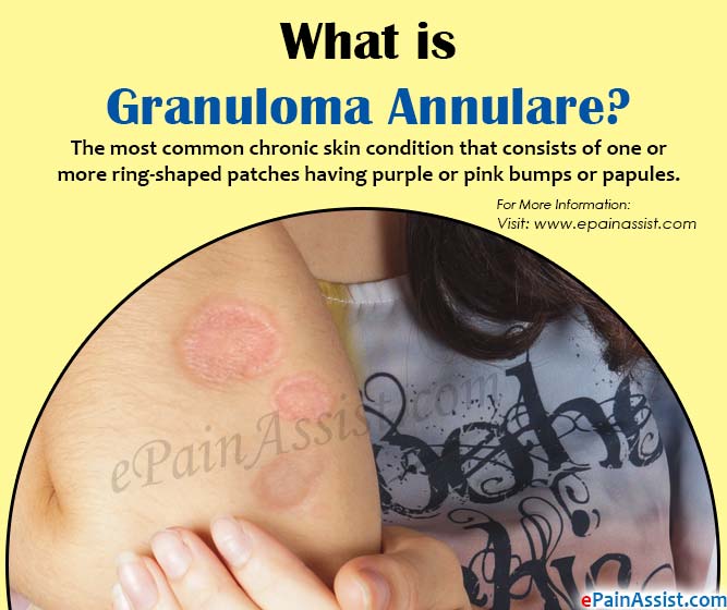 What is Granuloma Annulare?