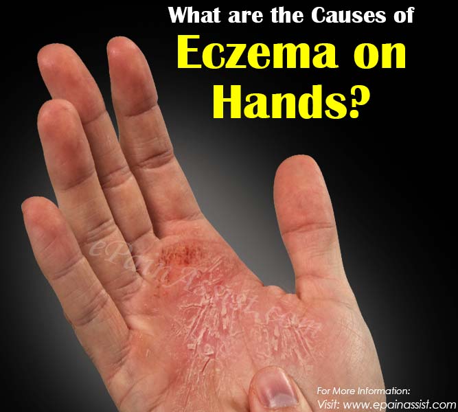 What are the Causes of Eczema on Hands?