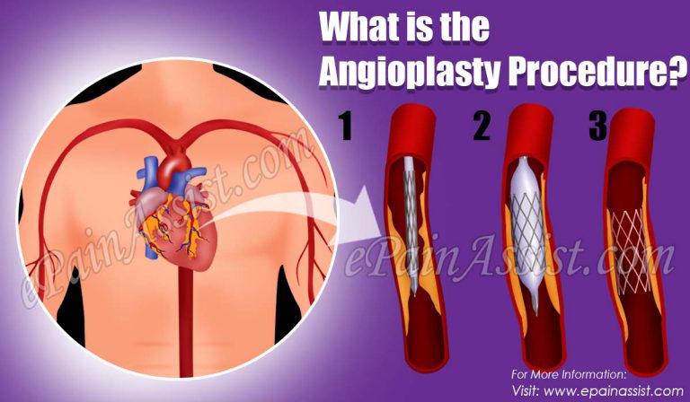 What is the Angioplasty Procedure?