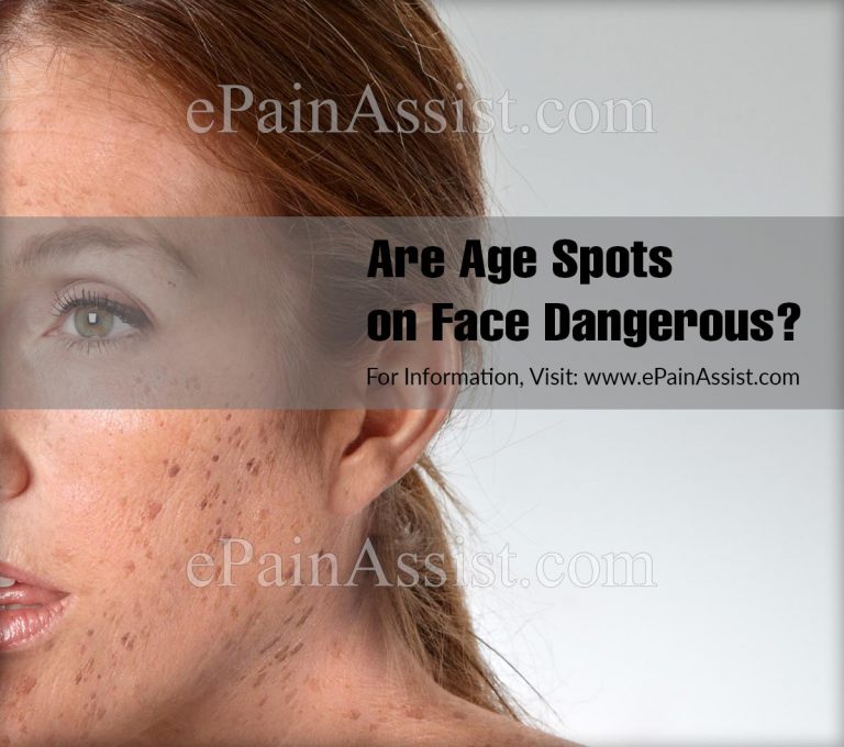 Are Age Spots On Face Dangerous?