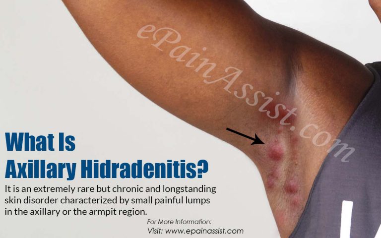 Axillary Hidradenitis: Causes, Symptoms, Treatment, Surgery