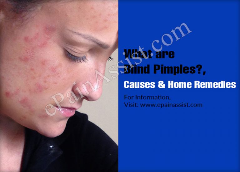 Blind Pimples: Causes and Home Remedies