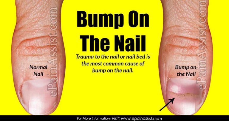Bump On The Nail: Causes & Treatment