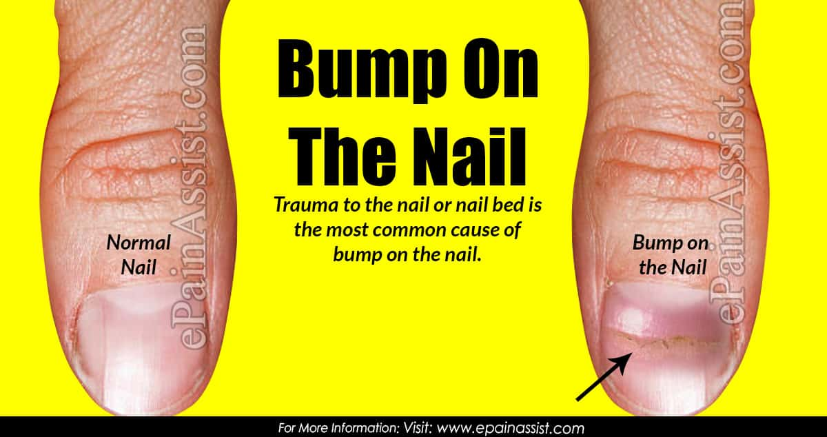 Bump On The Nail