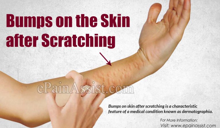 Bumps on the Skin after Scratching: Causes, Symptoms, Treatment, Prognosis, Prevention
