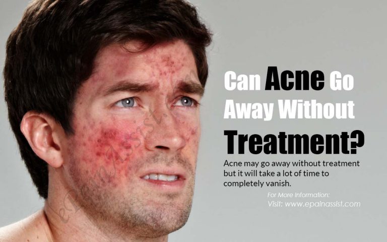 Can Acne Go Away Without Treatment & What Can Be Done About it?