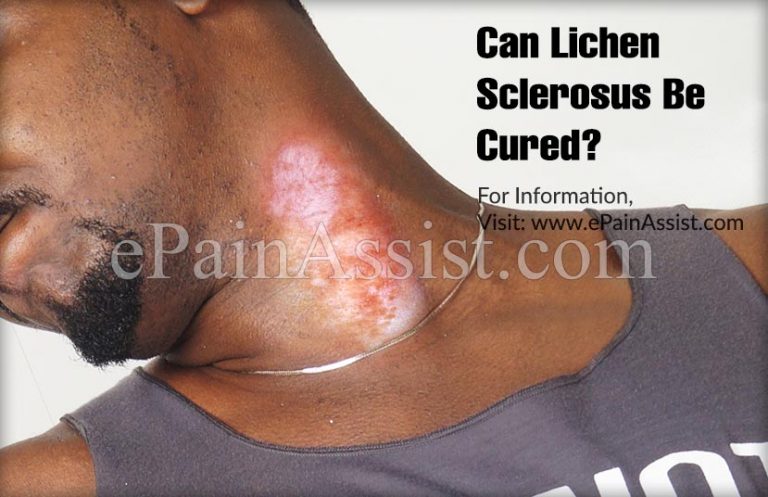 Can Lichen Sclerosus Be Cured?