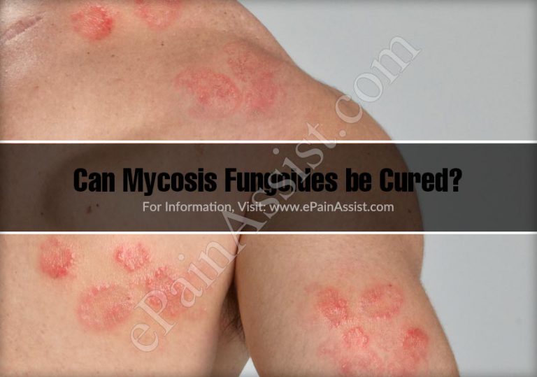 Can Mycosis Fungoides Be Cured?