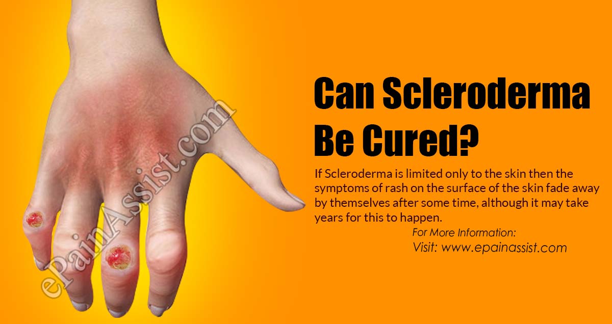 Can Scleroderma Be Cured?