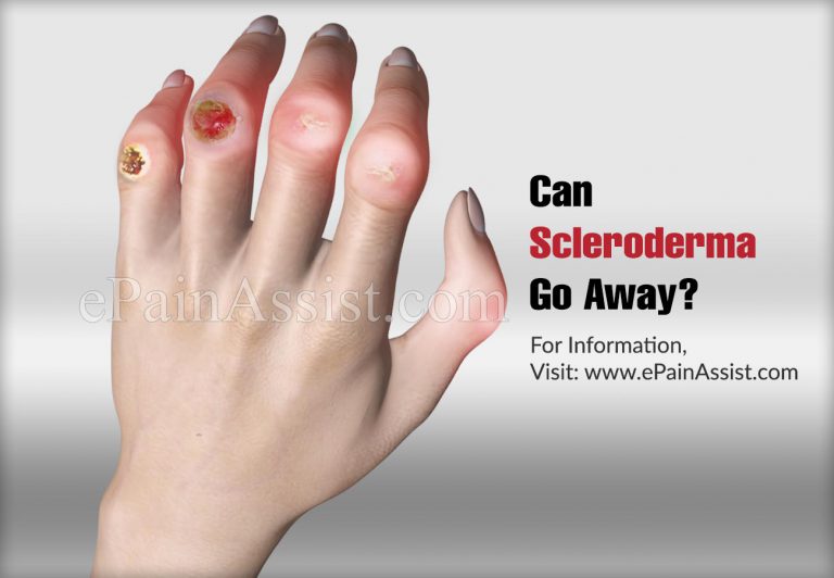Can Scleroderma Go Away?