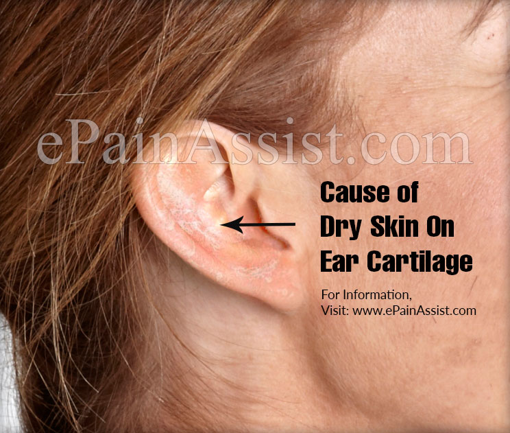 How To Get Rid Of Dry Skin Behind The Ears At Theresa Ferrell Blog