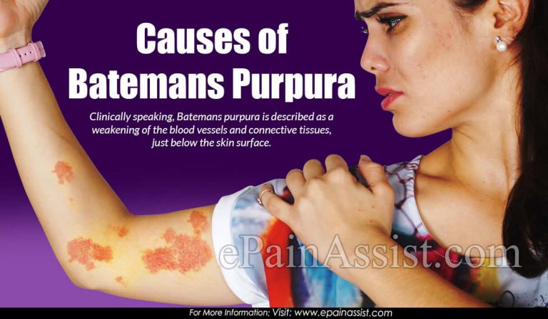 What is Batemans Purpura & How is it Treated?|Causes, Symptoms of Batemans Purpura