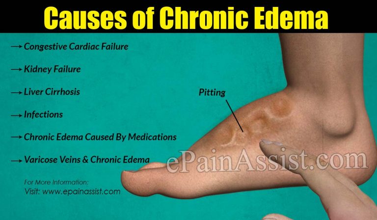 Causes of Chronic Edema & Its Treatment, Complications