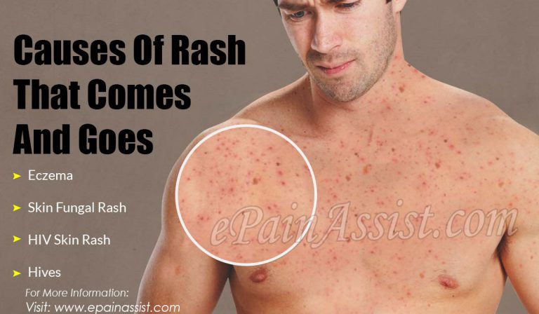 Causes of Rash That Comes and Goes & Its Treatment