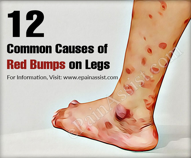 12 Common Causes of Red Bumps on Legs