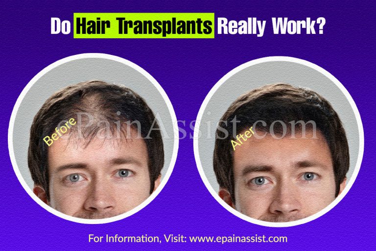 Do Hair Transplants Really Work & How Long Does It Last?