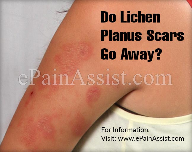 Do Lichen Planus Scars Go Away? 