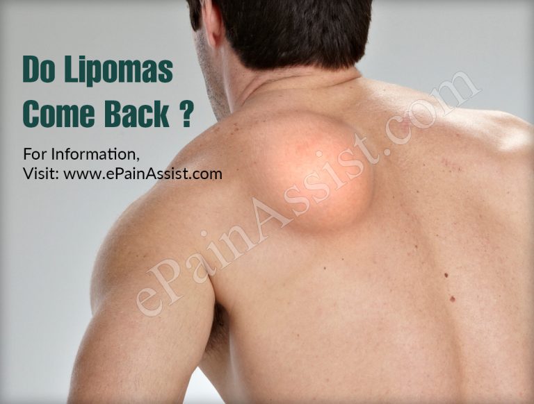 Do Lipomas Come Back?