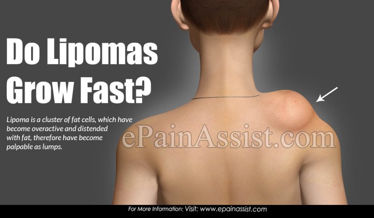 Do Lipomas Grow Fast?