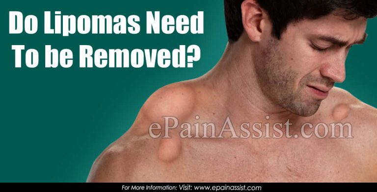 Do Lipomas Need To Be Removed?