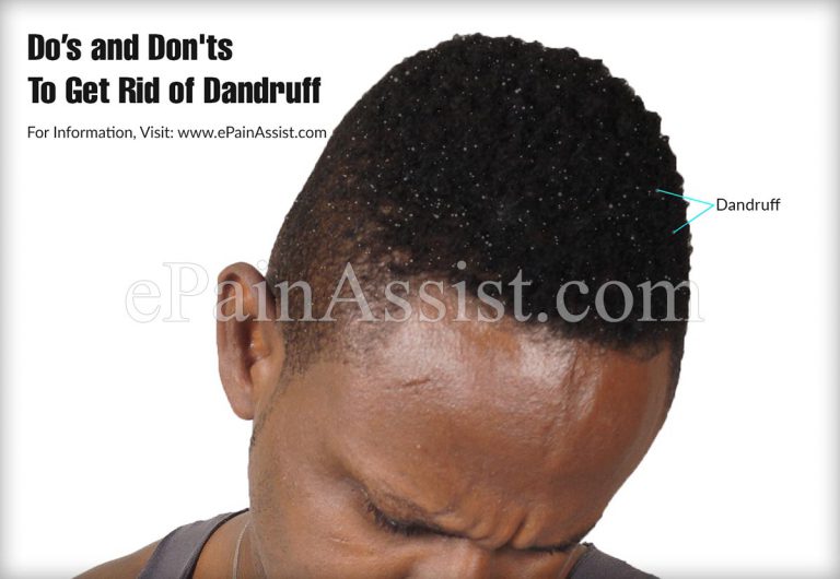 Do’s and Don’ts To Get Rid of Dandruff