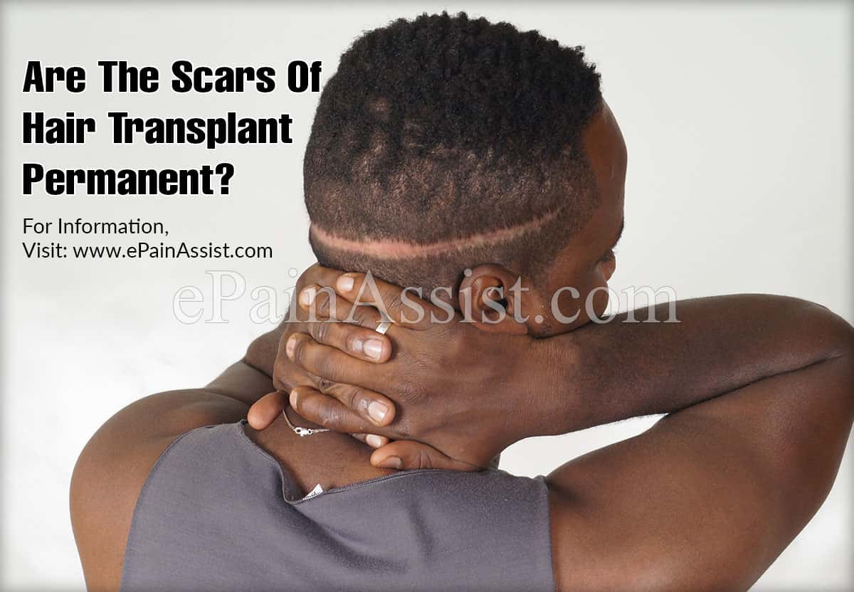 Are The Scars Of Hair Transplant Permanent?