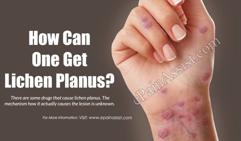 How Can One Get Lichen Planus?