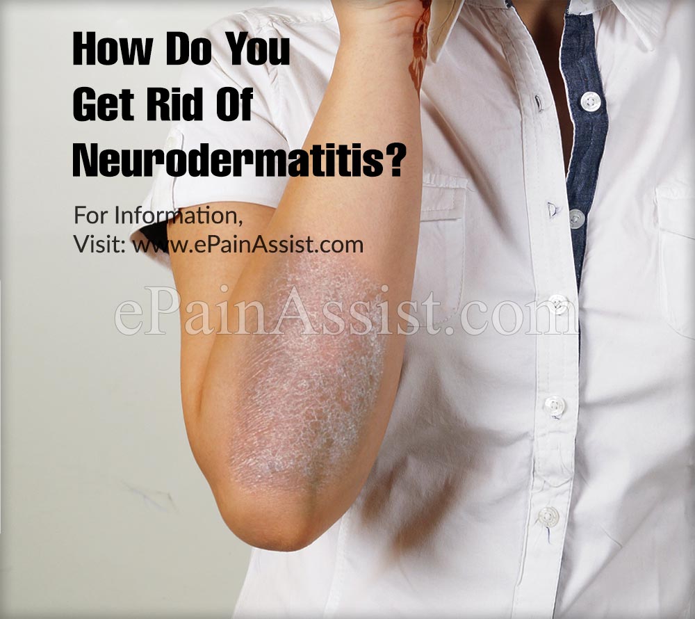 How Do You Get Rid Of Neurodermatitis? How Do You Get Rid Of Neurodermatitis?