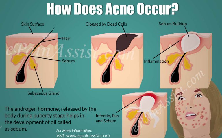 How Does Acne Occur & Can Acne be Cured?