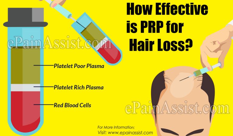 How Effective is PRP for Hair Loss?