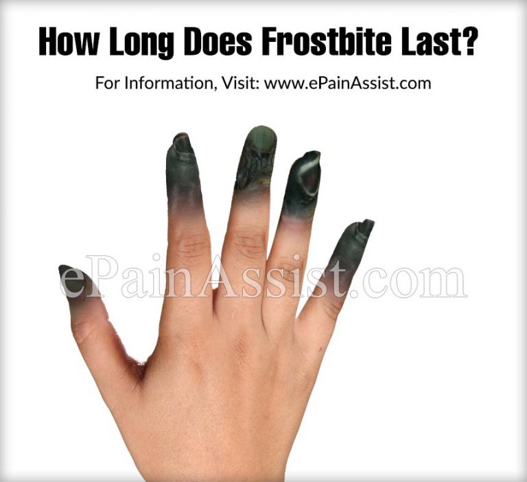 How Long Does Frostbite Last, Its Stages and 13 Home Remedies
