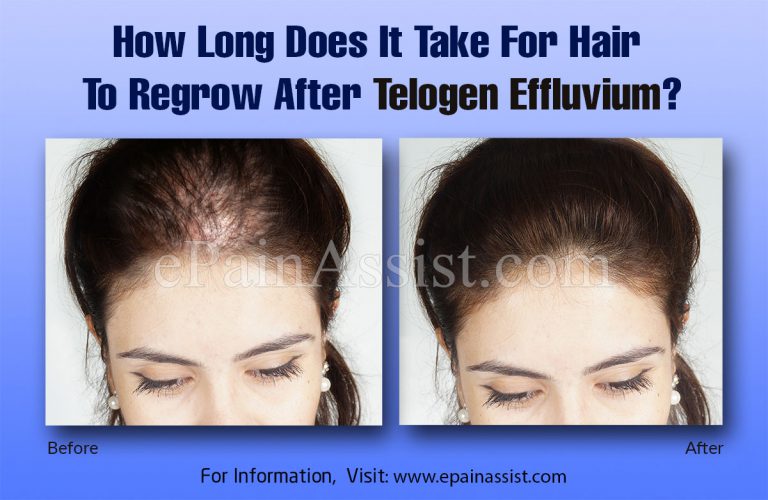 How Long Does It Take For Hair To Regrow After Telogen Effluvium?