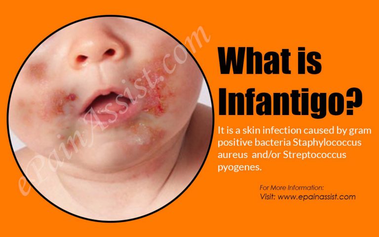Infantigo: Types, Causes, Symptoms, Treatment, Prognosis, Complications, Diagnosis