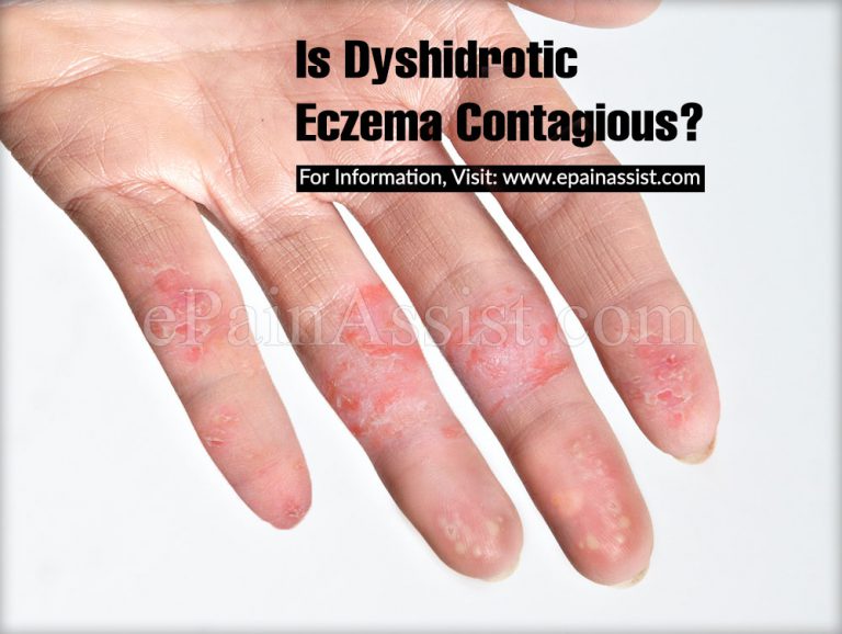 Is Dyshidrotic Eczema Contagious?