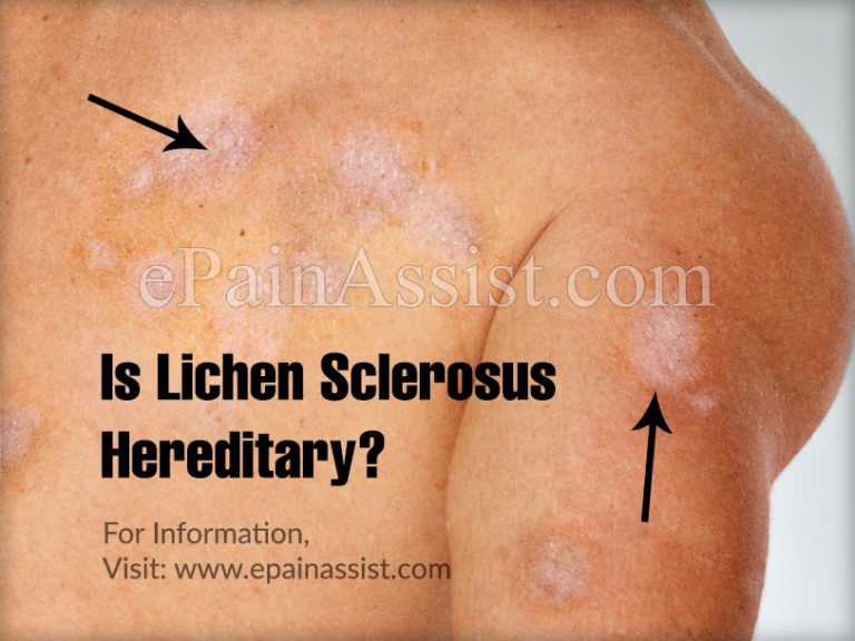 Is Lichen Sclerosus Hereditary?