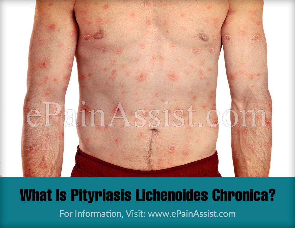 What Is Pityriasis Lichenoides Chronica?